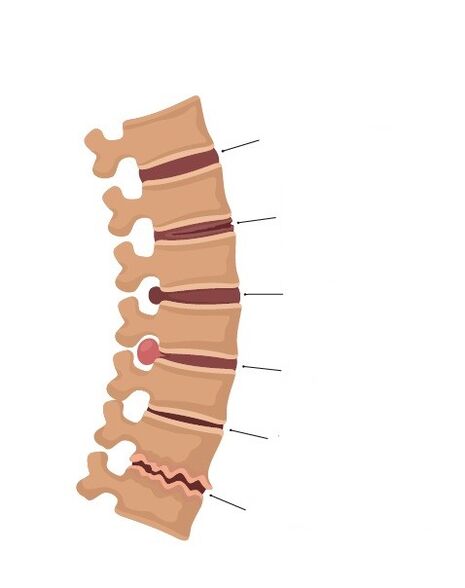 bony changes of the spinal column