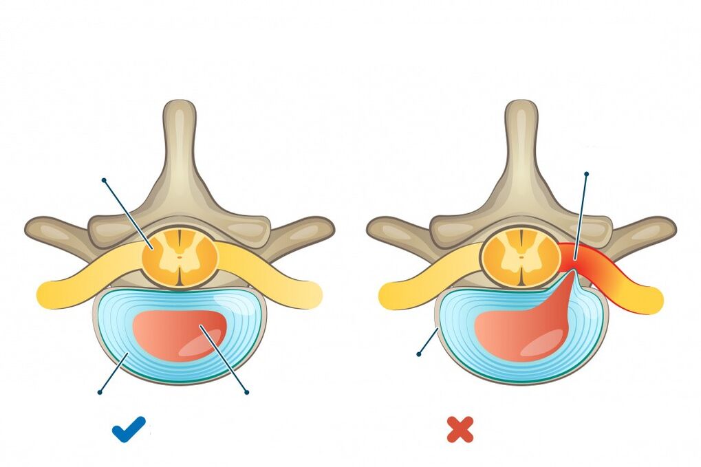 intervertebral discs - one healthy, the other with a hernia