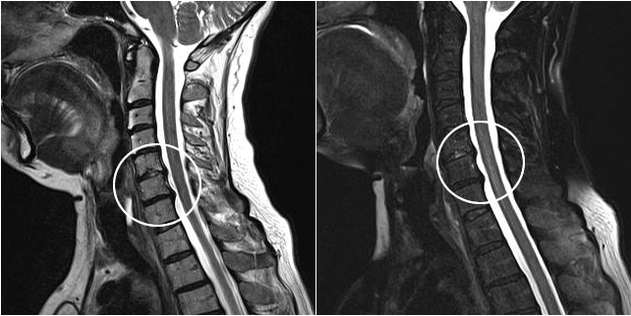 cervical osteochondrosis on MR imaging