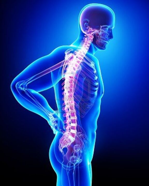 Human spine affected by osteochondrosis