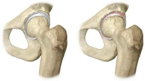 healthy hip joint affected by arthrosis